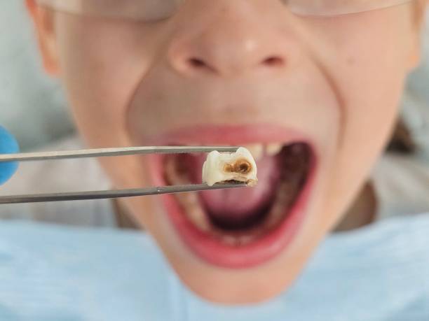 Best Urgent Care for Lost Fillings or Crowns in Como, WI